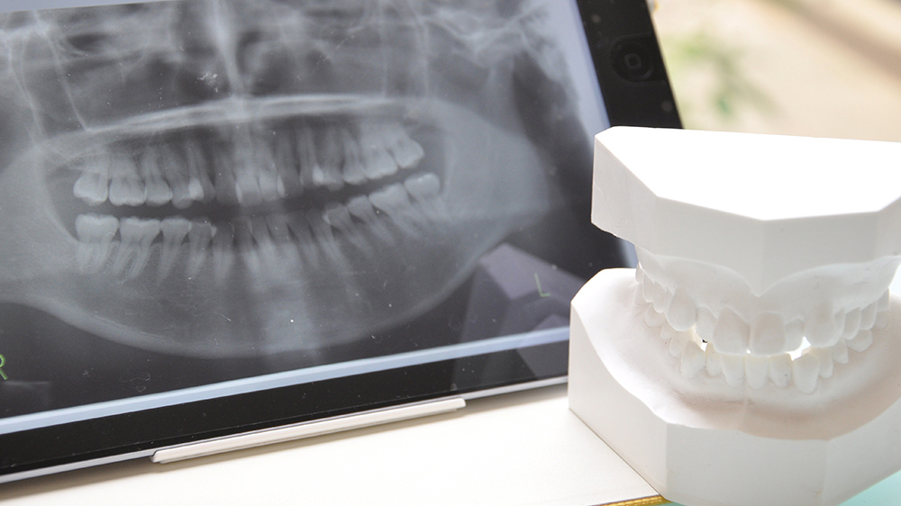 岩沼市のなるべく歯を削らない治療
