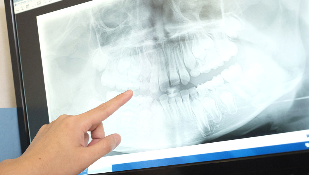 岩沼市のなるべく歯を削らない治療