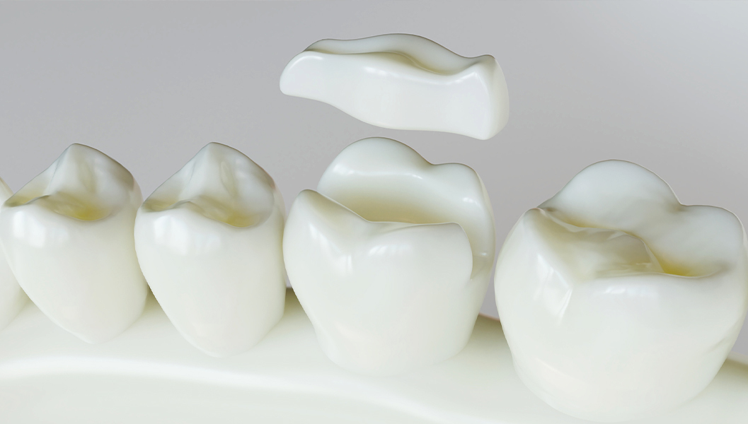 岩沼市のなるべく歯を削らない治療